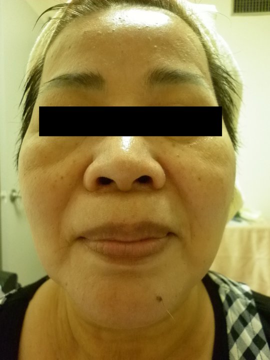 【資深熟女美麗改造 變身重拾年輕自信】術前照(3)