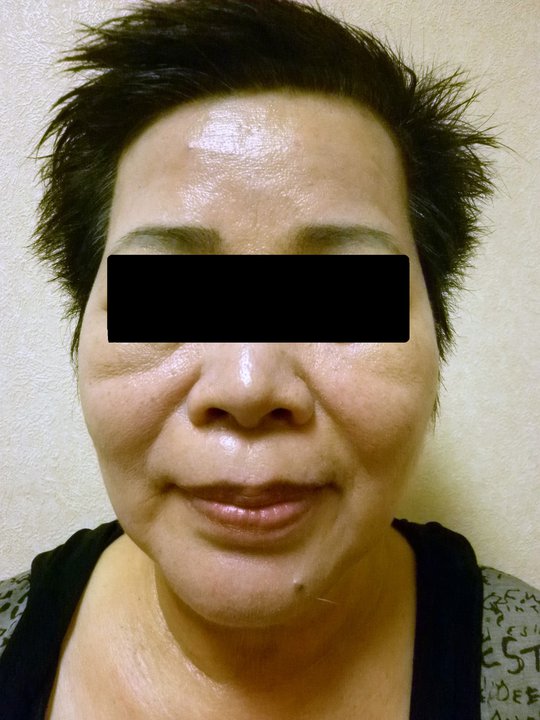 【資深熟女美麗改造 變身重拾年輕自信】術後照(1)