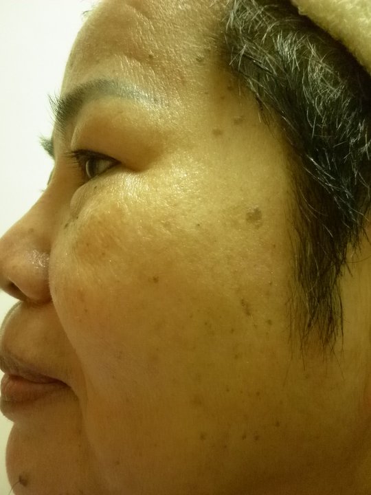 【資深熟女美麗改造 變身重拾年輕自信】術前照(1)