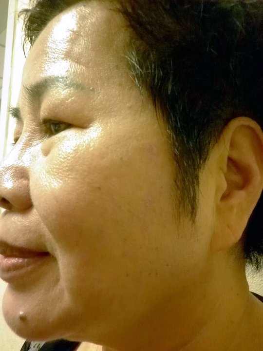 【資深熟女美麗改造 變身重拾年輕自信】術後照(3)