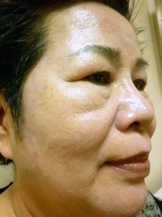 【資深熟女美麗改造 變身重拾年輕自信】術後照(2)